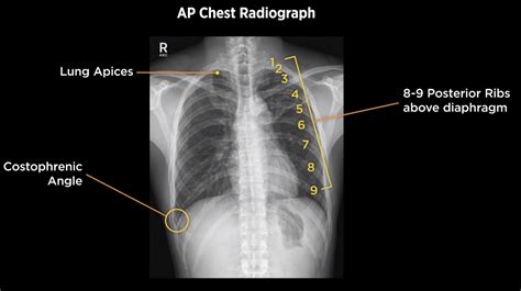 X ray chest lordotic view (Ep.